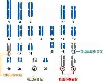 染色体异常导致的智力障碍