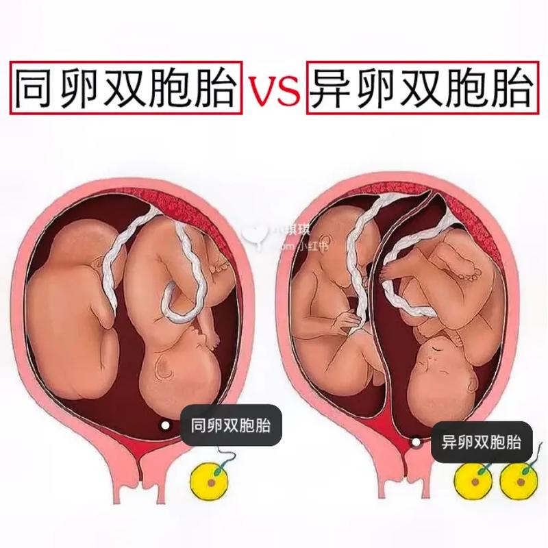 同卵双胞胎和异卵双胞胎的区别是什么