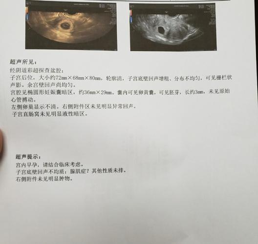 8周胎停是什么原因引起的 胎心消失了一定就是胎停吗